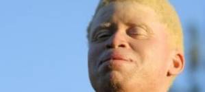Albinos in Tanzania Albinos in Tanzania