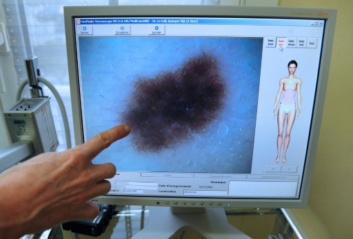 Le cancer de la peau, une réalité bien bretonne