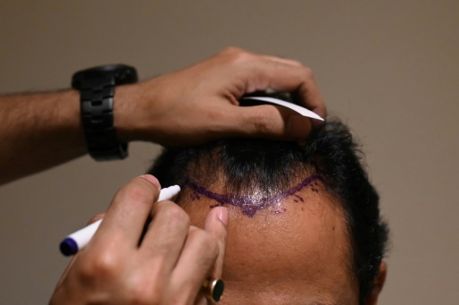 Hair transplant fad turns deadly in India